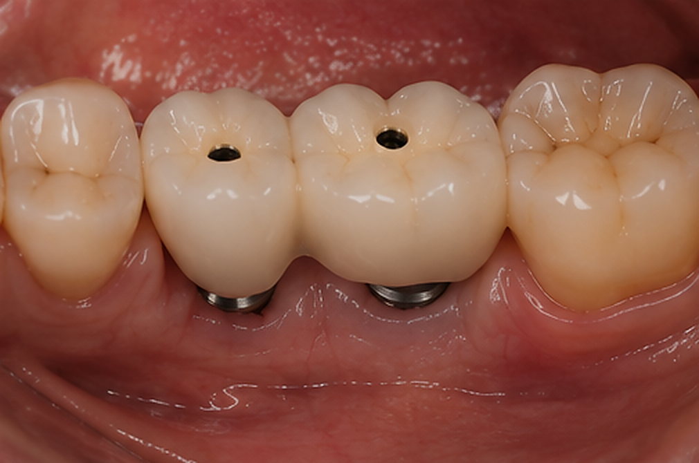 Ajustements : Réhabilitation molaire sur implants
