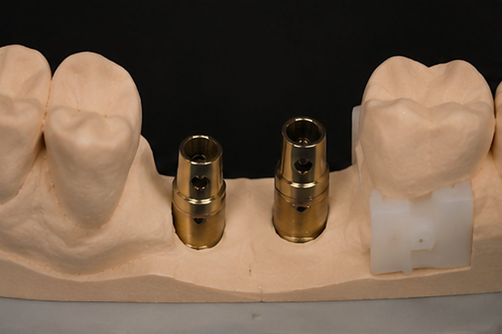 Conception : Réhabilitation molaire sur implants