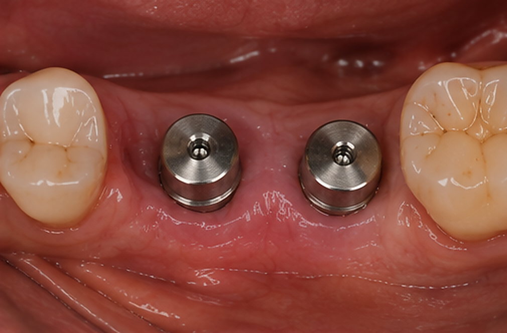 Restauration : Réhabilitation molaire sur implants