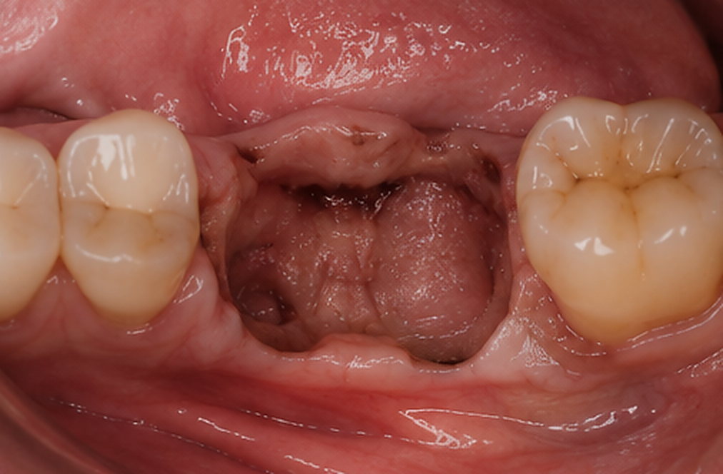 Situation : Réhabilitation molaire sur implants
