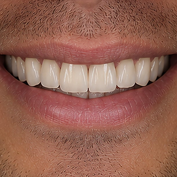 Le sourire terminé. Vue d'ensemble après pose.