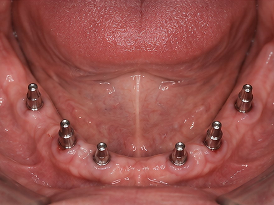 Technique : Réhabilitation complète sur implants