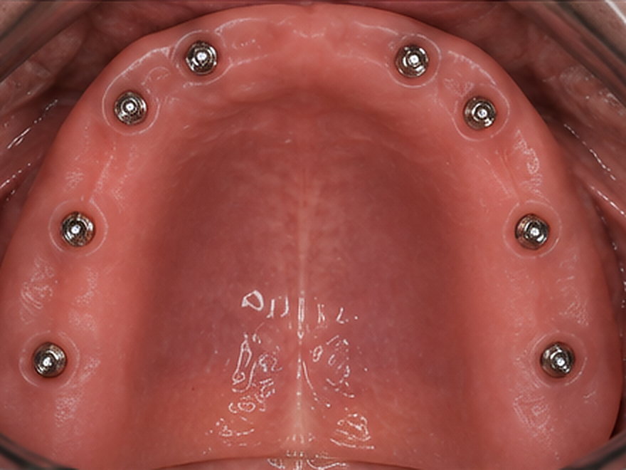 Solution retenue : Réhabilitation complète sur implants