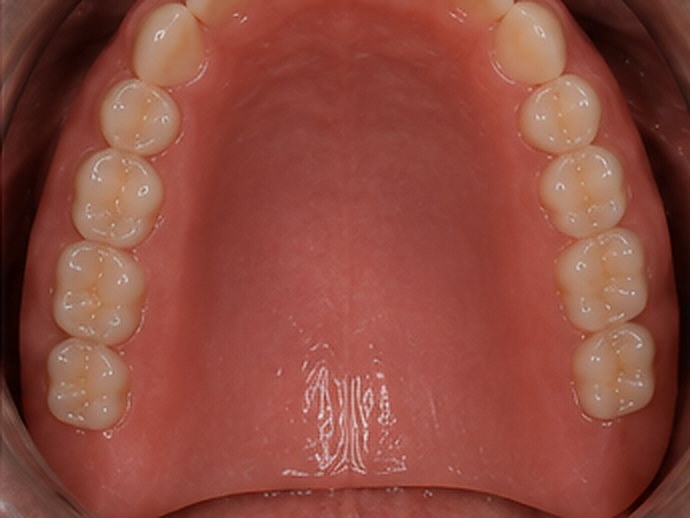 Points contrôlés : Réhabilitation complète sur implants