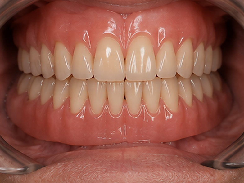 Ajustements : Réhabilitation complète sur implants