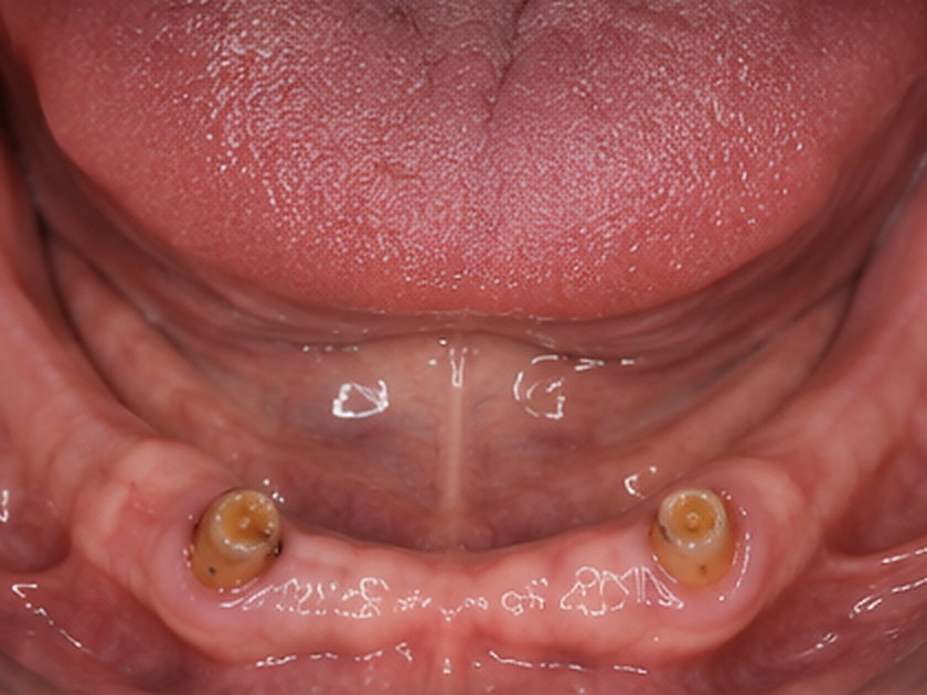 Problématique prothétique : Réhabilitation complète sur implants